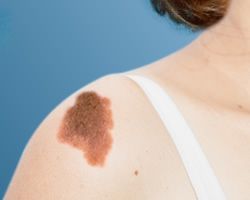 A woman has a brown spot on her shoulder.
