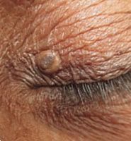 A close up of a person 's eye with a comedone lump on eyelid.
