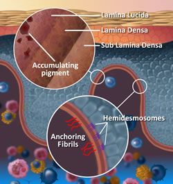 A diagram showing the layers of the skin including accumulating pigment and anchoring fibrils