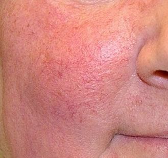 A close up of a person 's face with red veins.