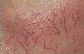 A close up of a person 's face with red veins.