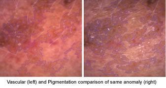 Two pictures of a person 's skin showing vascular ( left ) and pigmentation comparison of same anomaly ( right ).