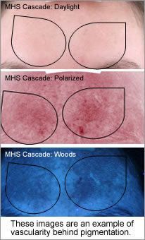These images are an example of vascularity behind pigmentation