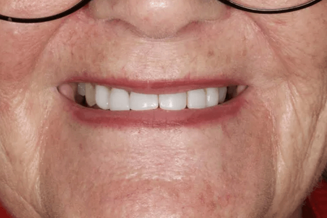Close-up of a smiling mouth with teeth visible and glasses at the top of the frame