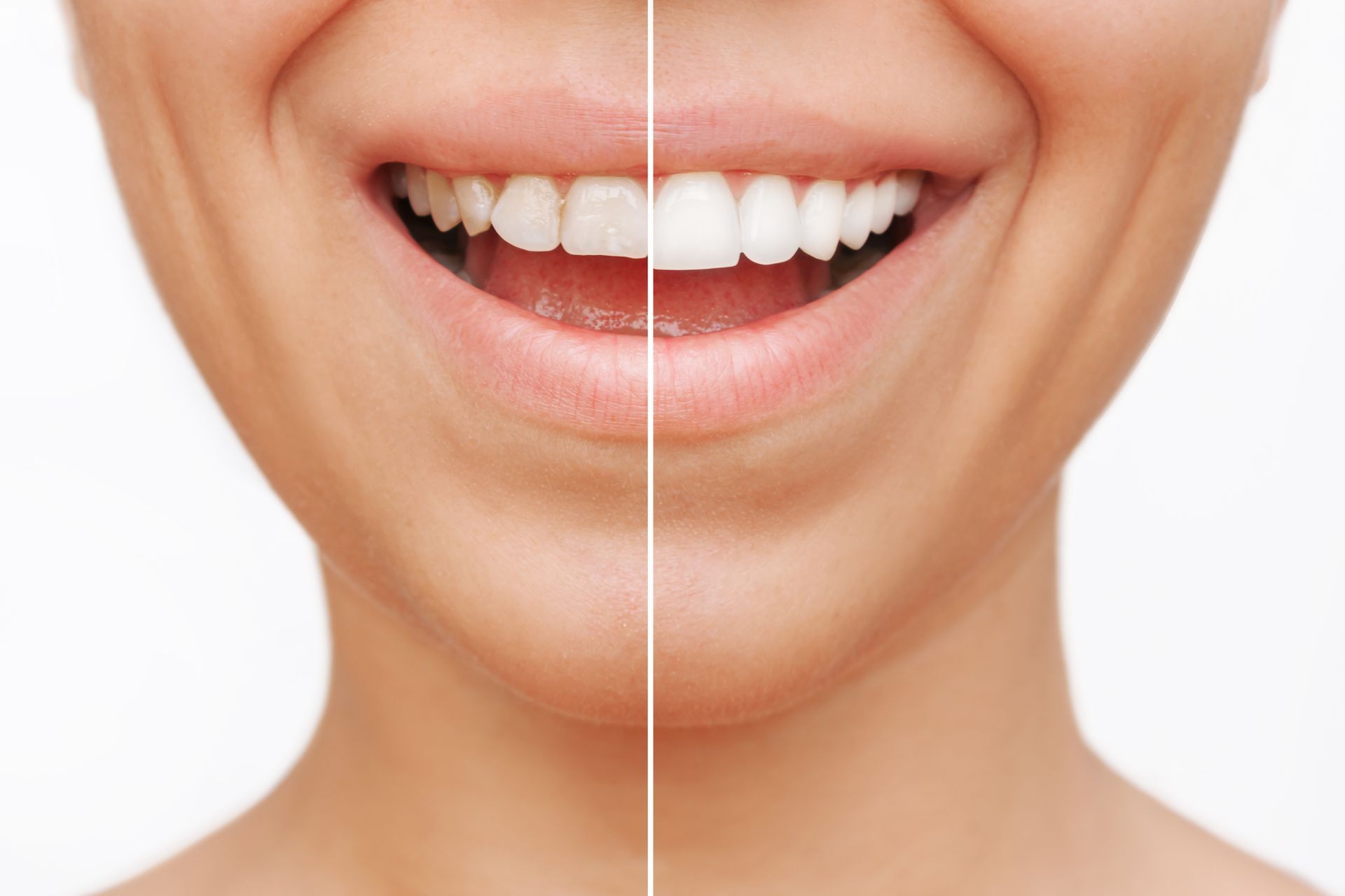 Cropped shot of a smiling woman showing her before and after veneers were placed.