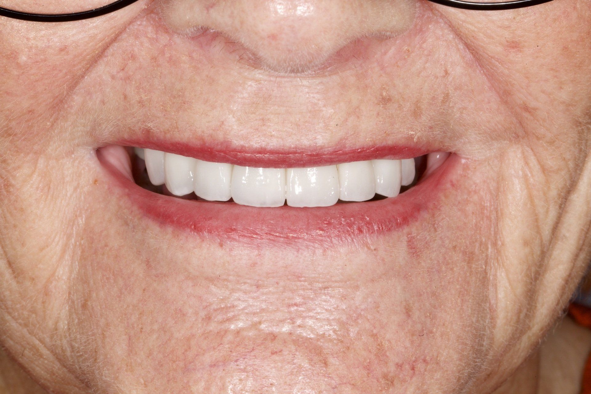 Close-up of a smiling mouth with white teeth and glasses visible above the nose