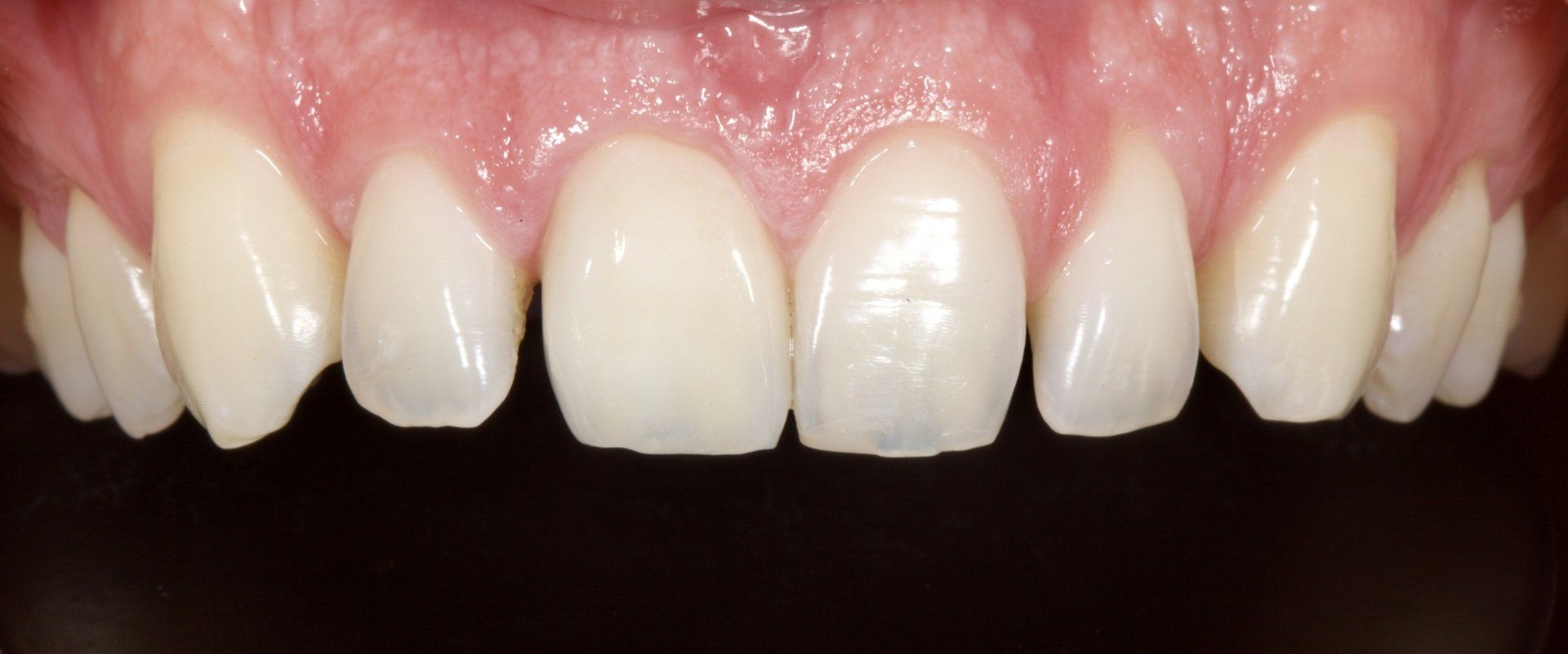 Close-up of upper front teeth with a white tooth centered among slightly yellowed teeth