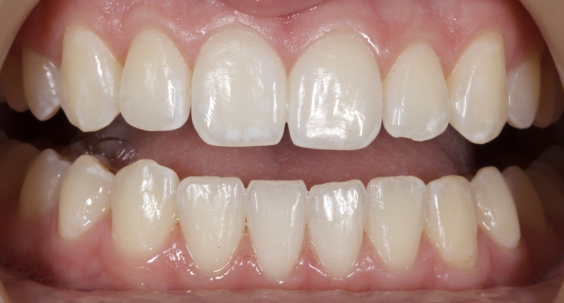 Close-up of a person's open mouth showing upper and lower teeth with a noticeable gap between the front teeth