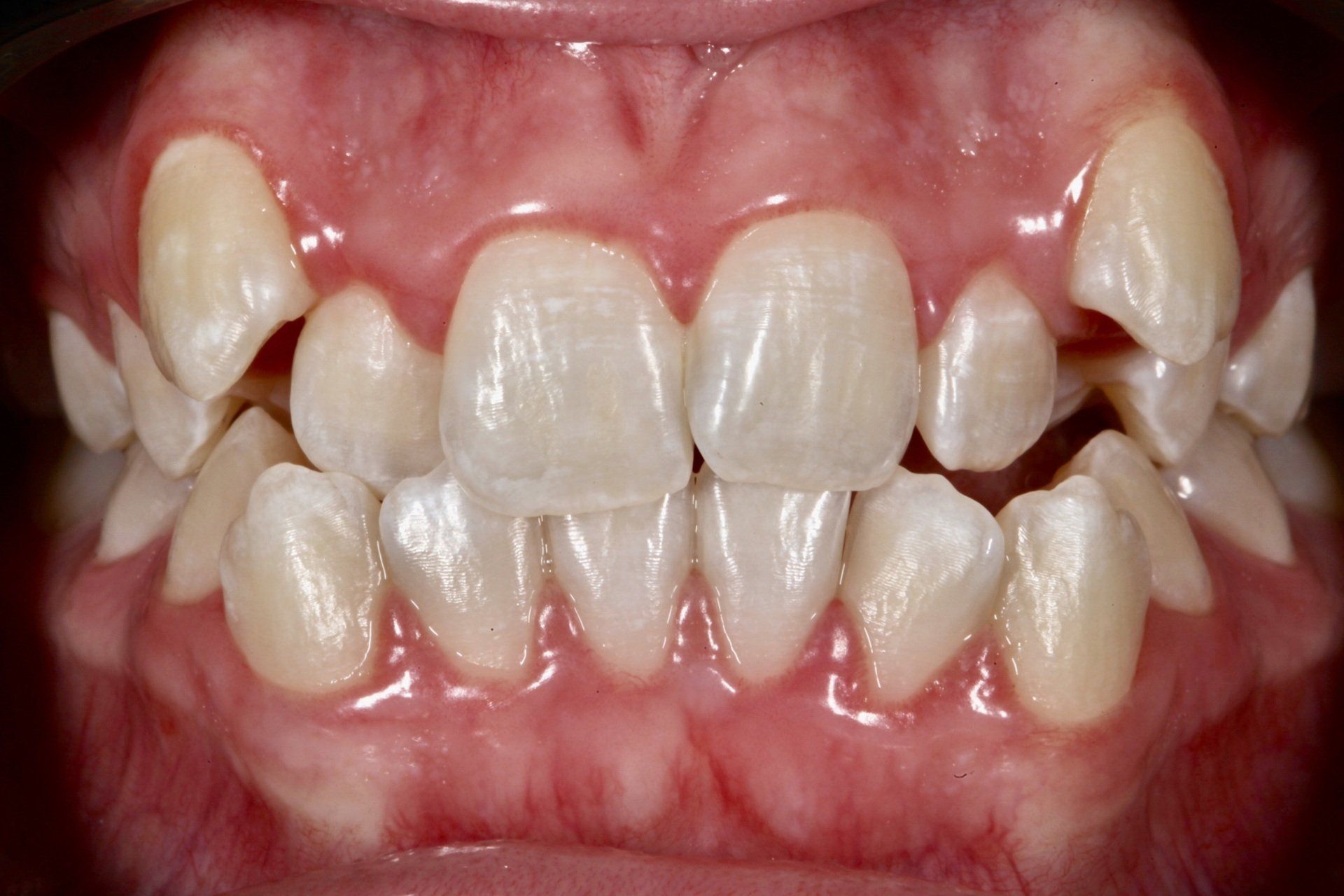 Close-up of crowded teeth with severe misalignment and overlapping incisors.
