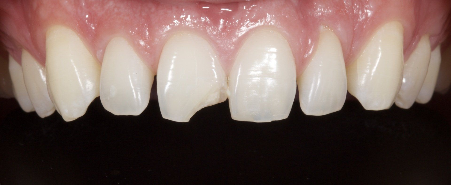 Close-up of upper front teeth and gums, showing a dental smile with slightly misaligned teeth.