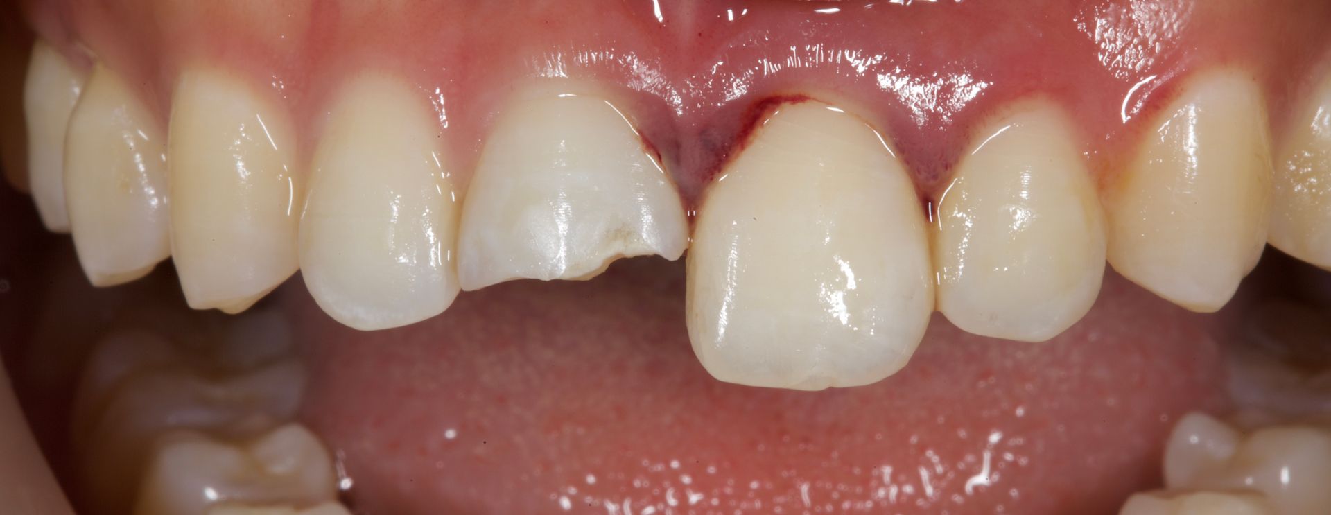 Close-up of upper front teeth with a missing central tooth, showing a gap in the smile