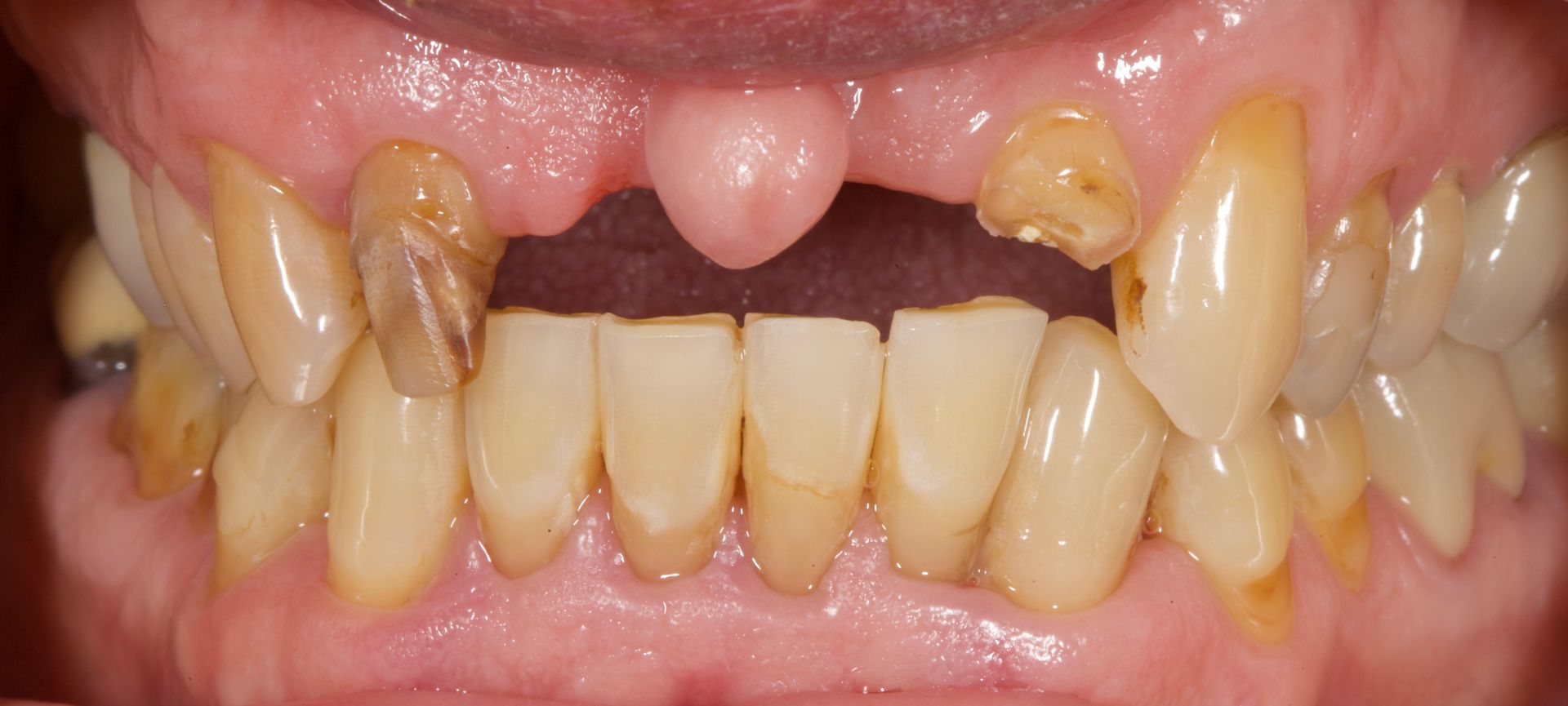 Close-up of severely decayed and missing teeth with exposed gums and broken upper front teeth