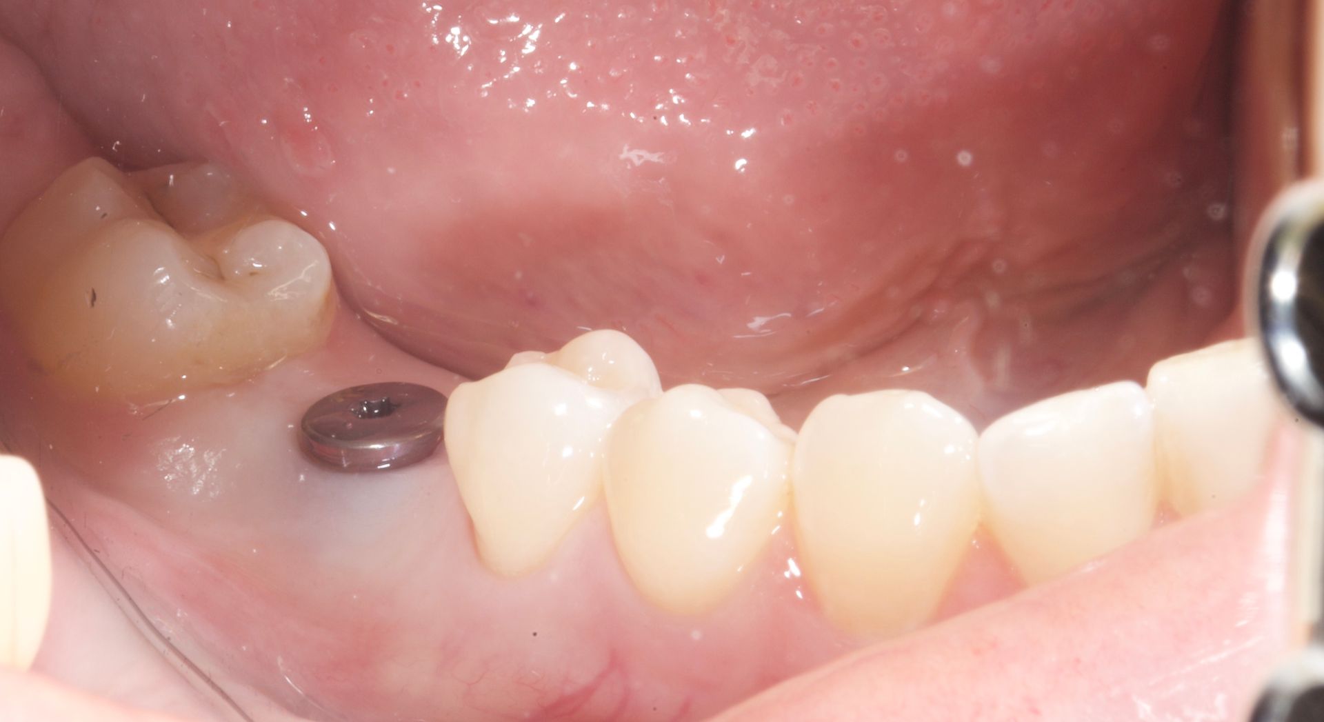 Lower jaw gums with a metal dental implant post beside front teeth