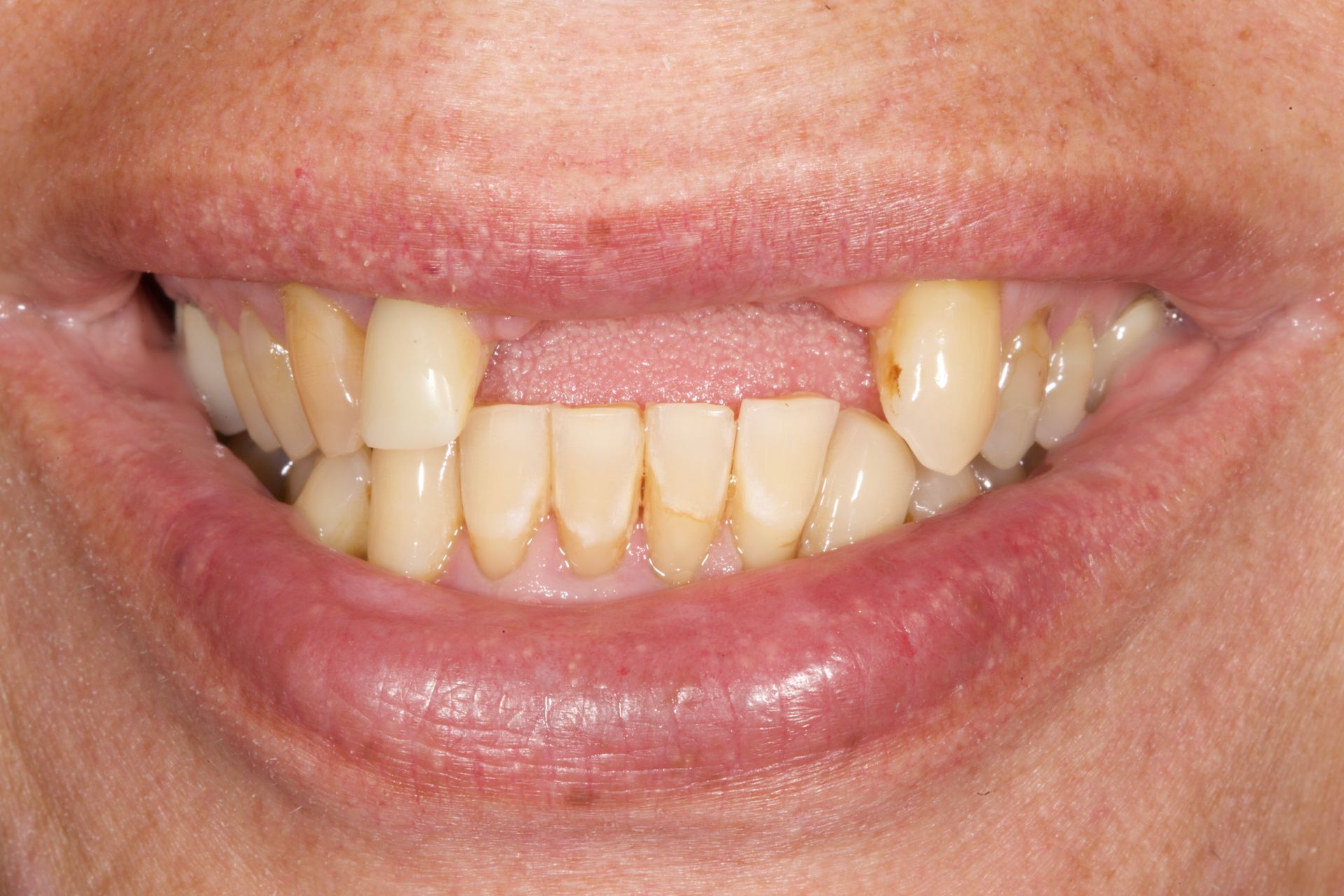 Close-up of a smiling mouth with crooked, stained teeth and missing upper front teeth