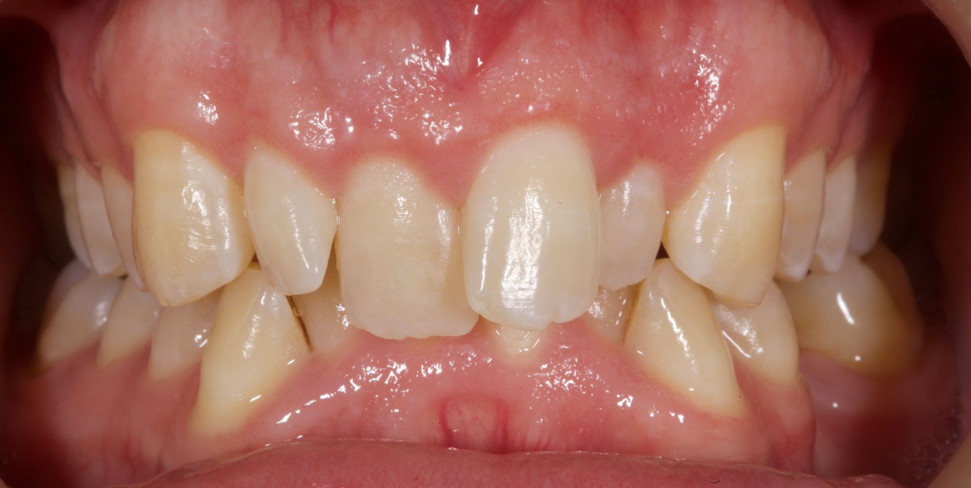 Close-up of misaligned upper and lower teeth, showing a gap and crowded front incisors
