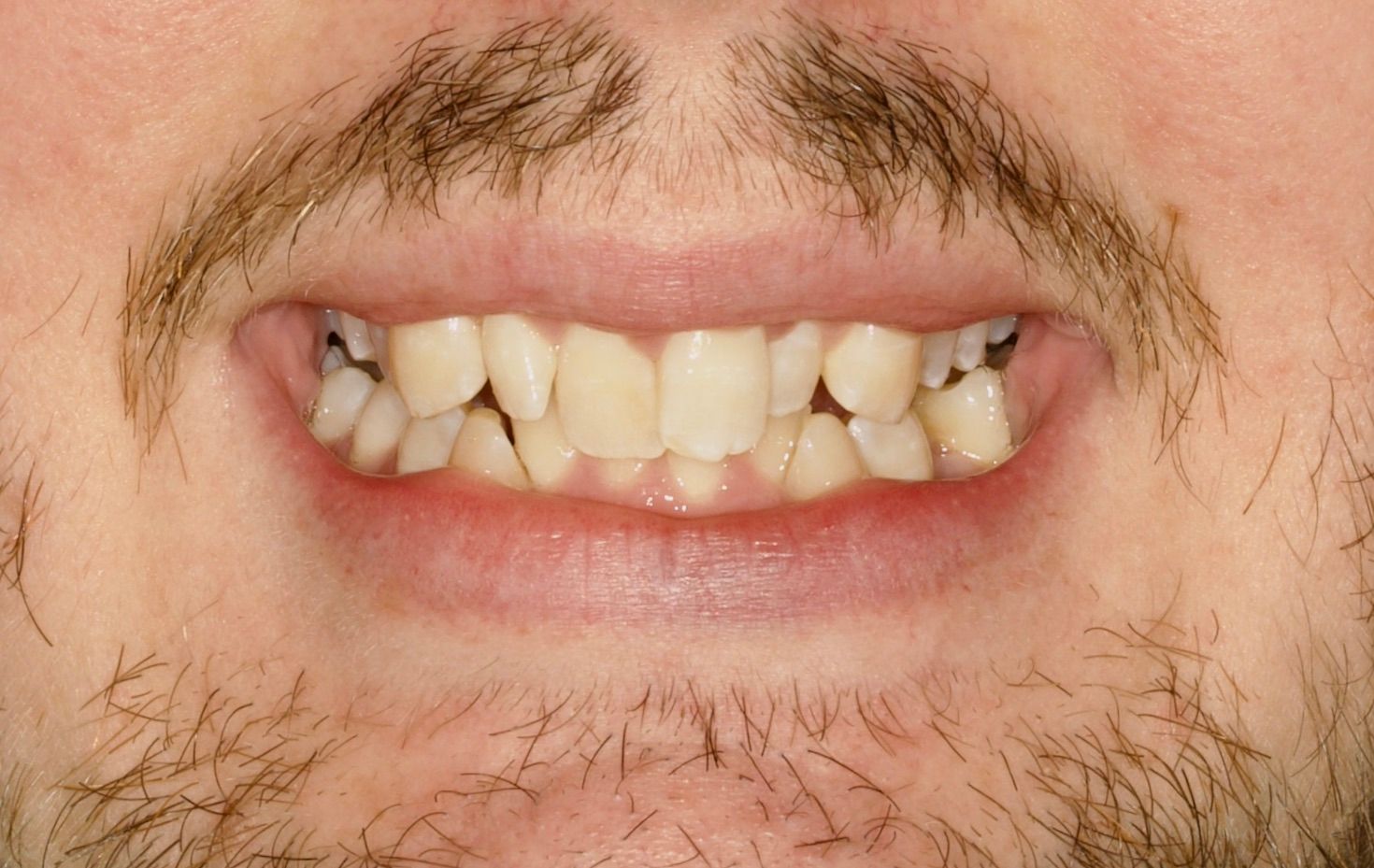 Close-up of a person smiling, showing crowded and misaligned teeth.