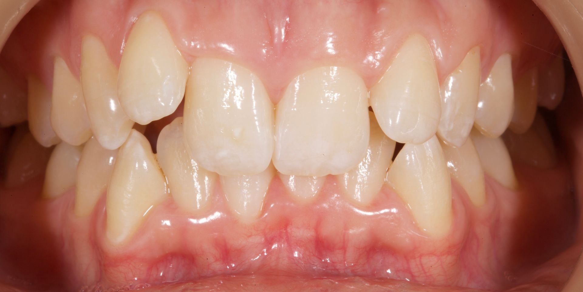 Close-up of open mouth showing upper and lower teeth and pink gums with slight crowding
