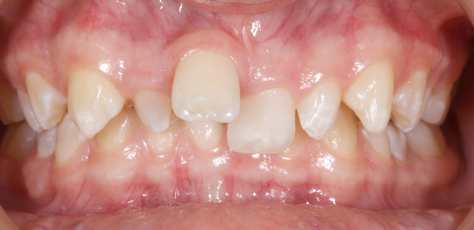 Close-up of teeth with crowded front teeth and visible gaps in the gums.