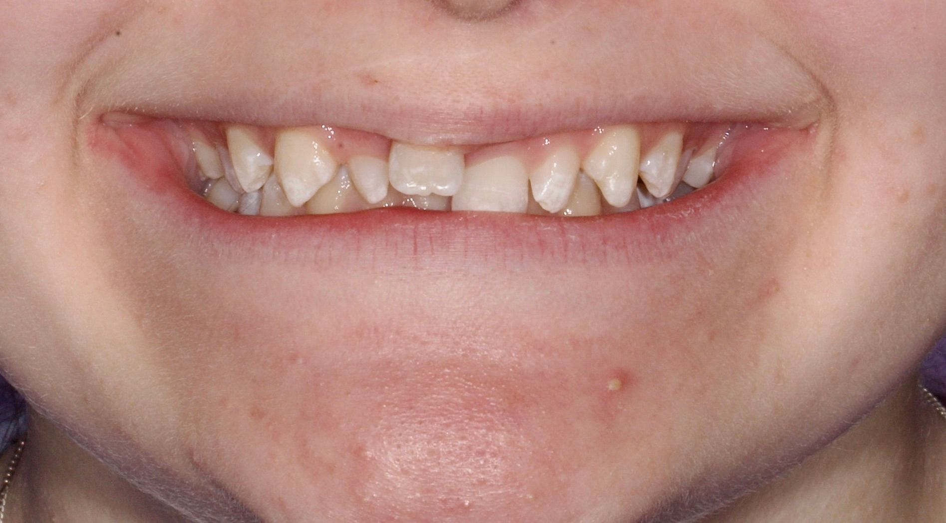 Close-up of a smiling mouth with uneven front teeth and a small blemish on the chin