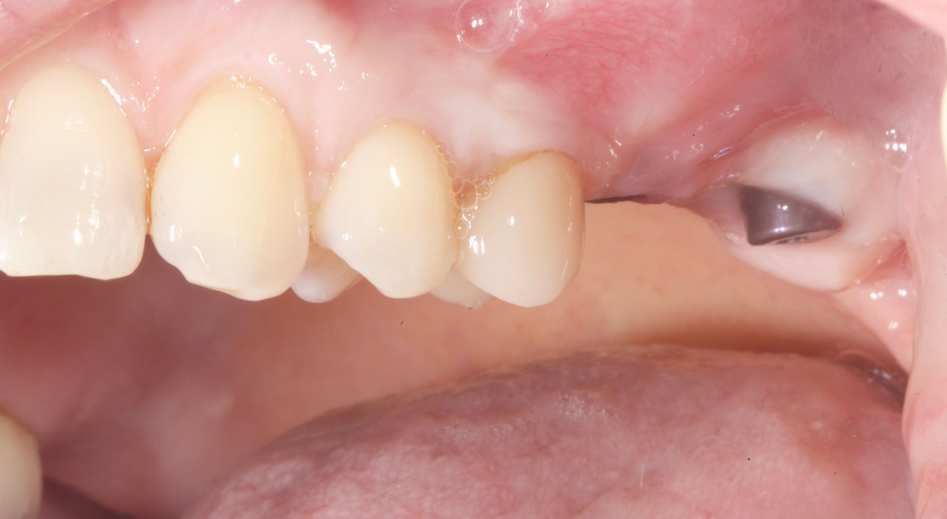 Close-up of upper front teeth and gums, with a missing tooth space and metal dental filling visible