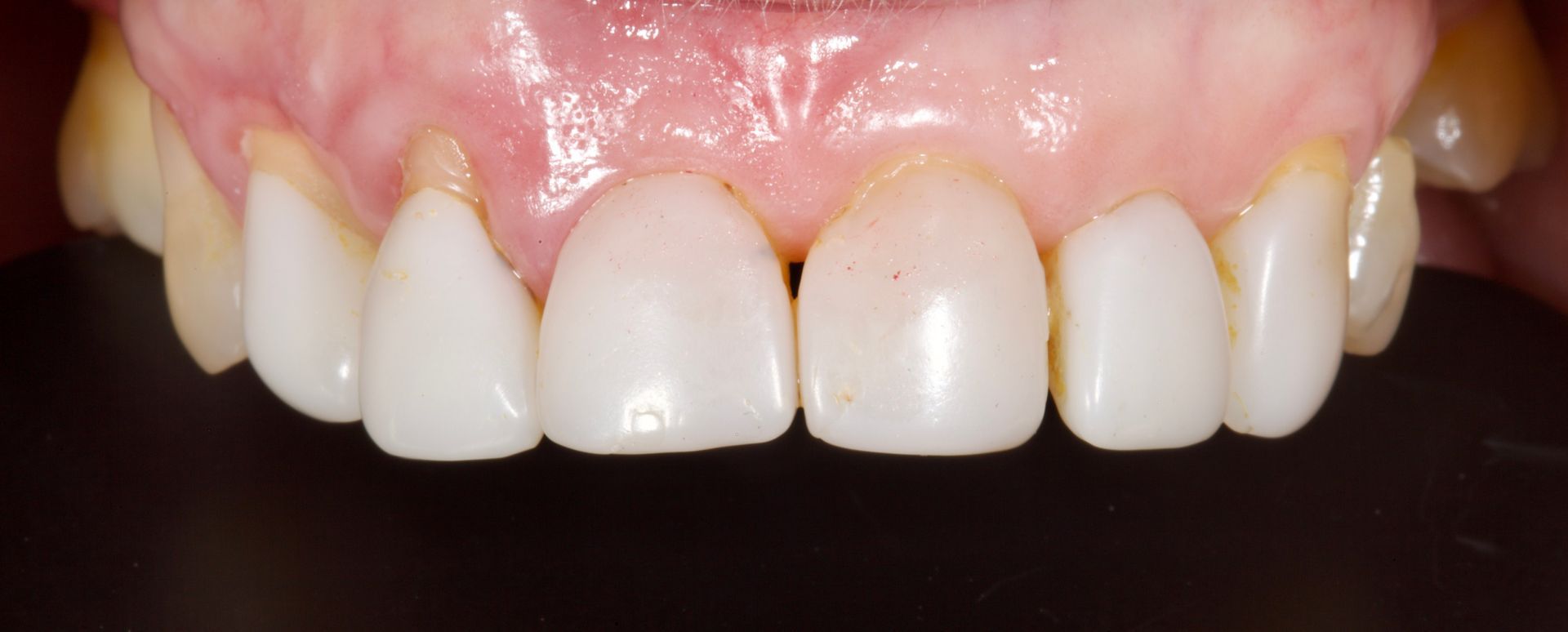 Close-up of front teeth and gums with slight yellowing and a small gap between teeth