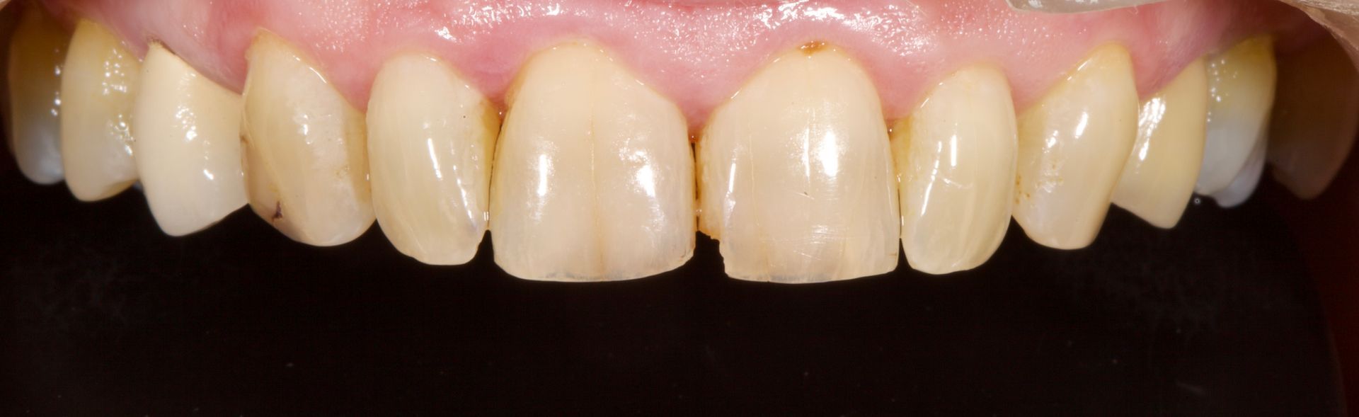 Close-up of upper front teeth with yellowish staining and discoloration