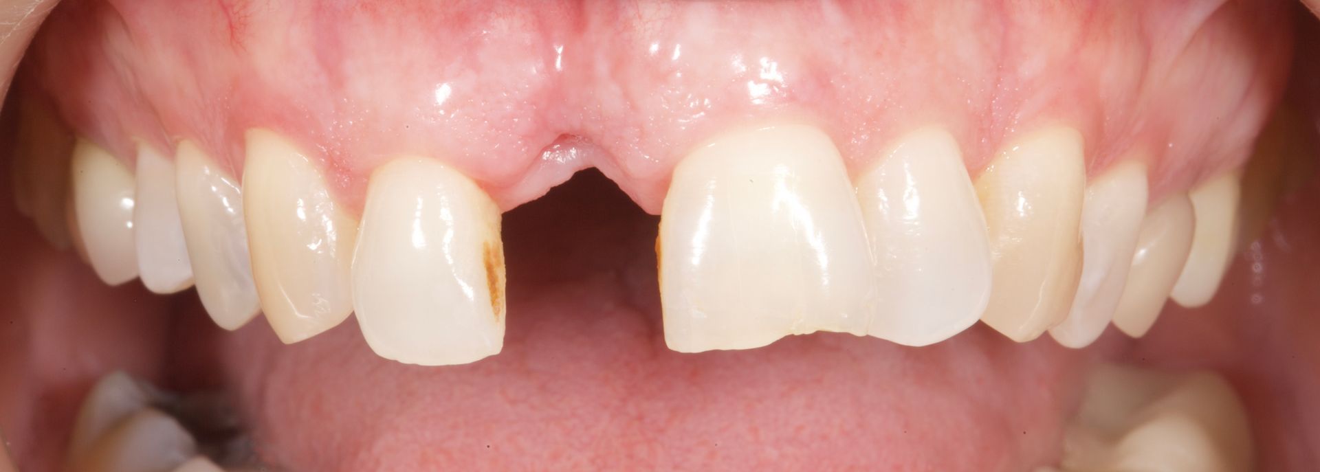 Close-up of upper front teeth with gaps and one missing tooth, showing pink gums
