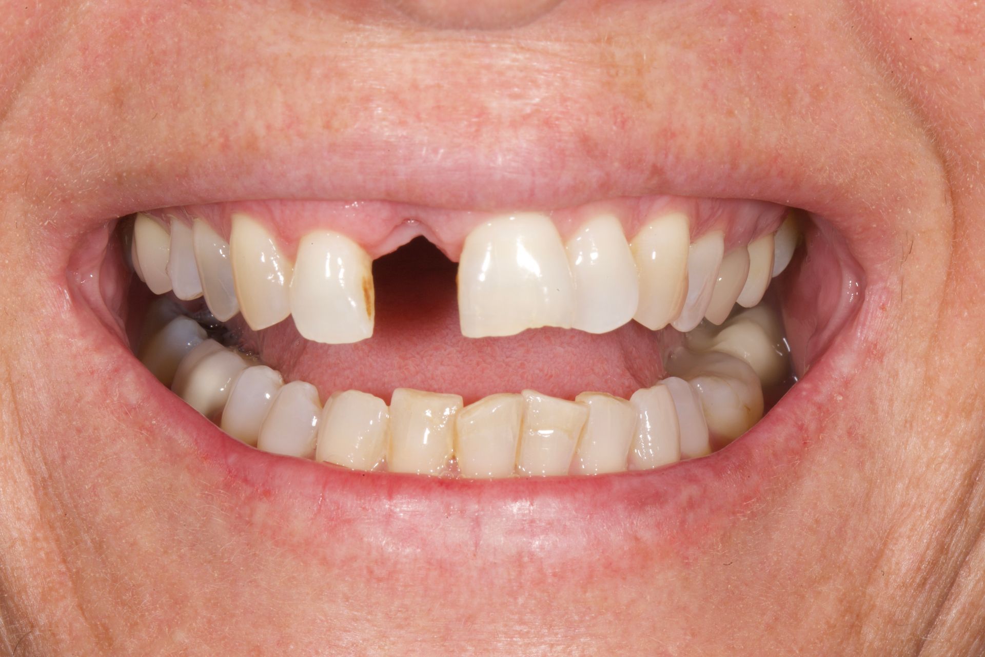 Close-up of a smiling mouth with a missing upper front tooth and visible lower teeth