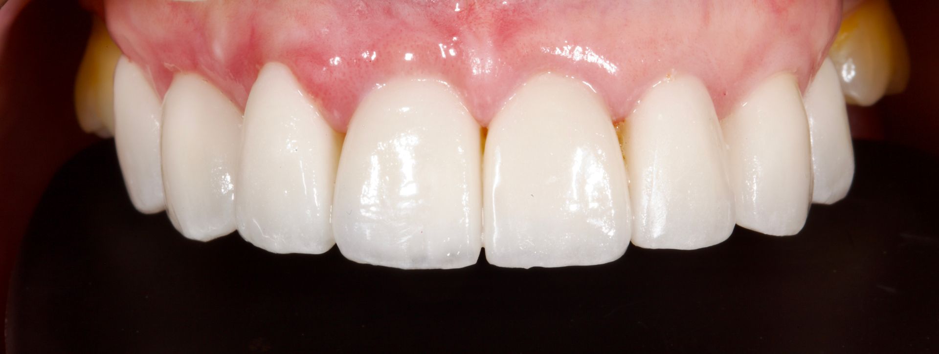 Close-up of a person’s white upper teeth and pink gums while smiling