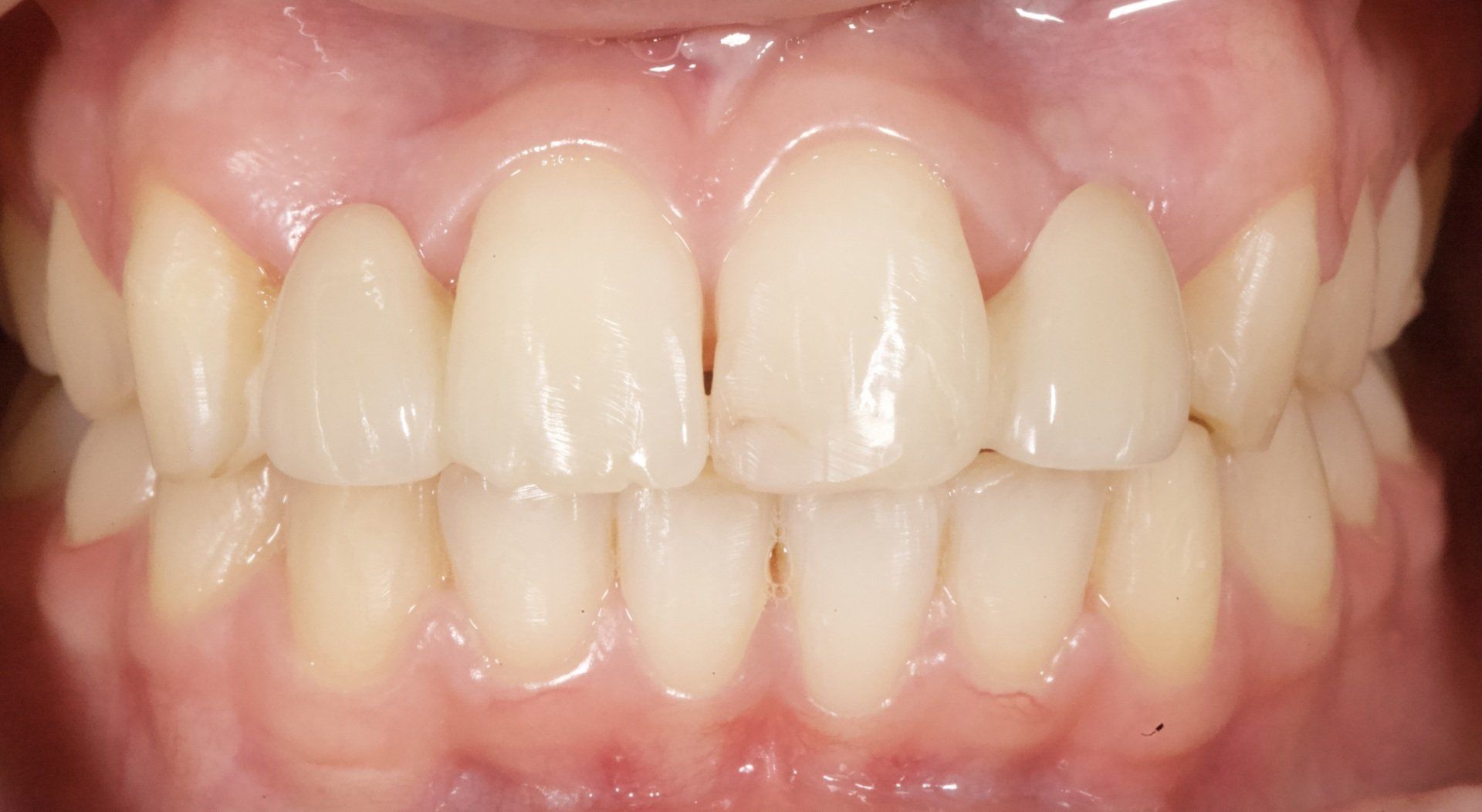 Close-up of a mouth showing straight white teeth and pink gums while smiling