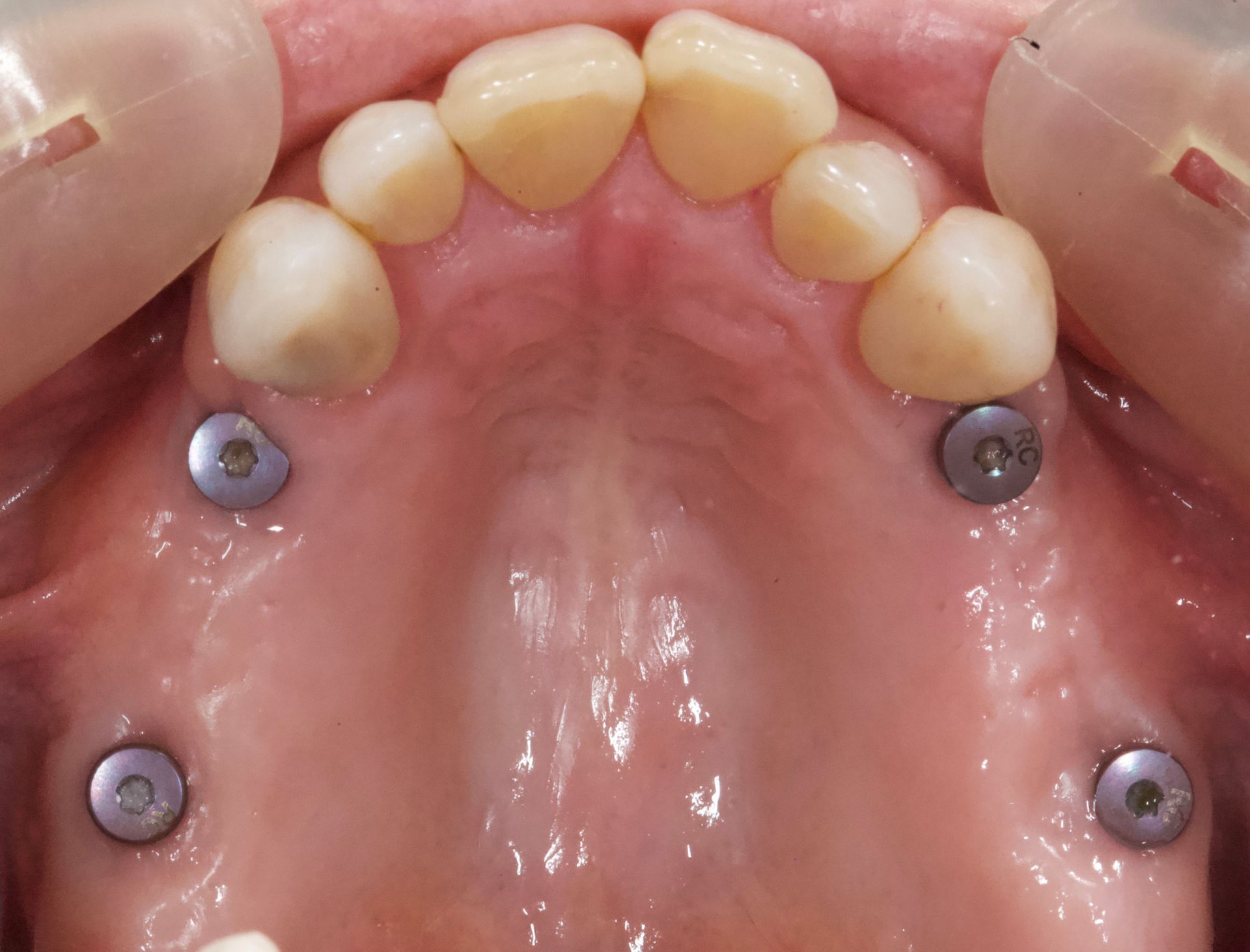 Upper mouth with dental implants and front teeth visible, pink palate and gums.