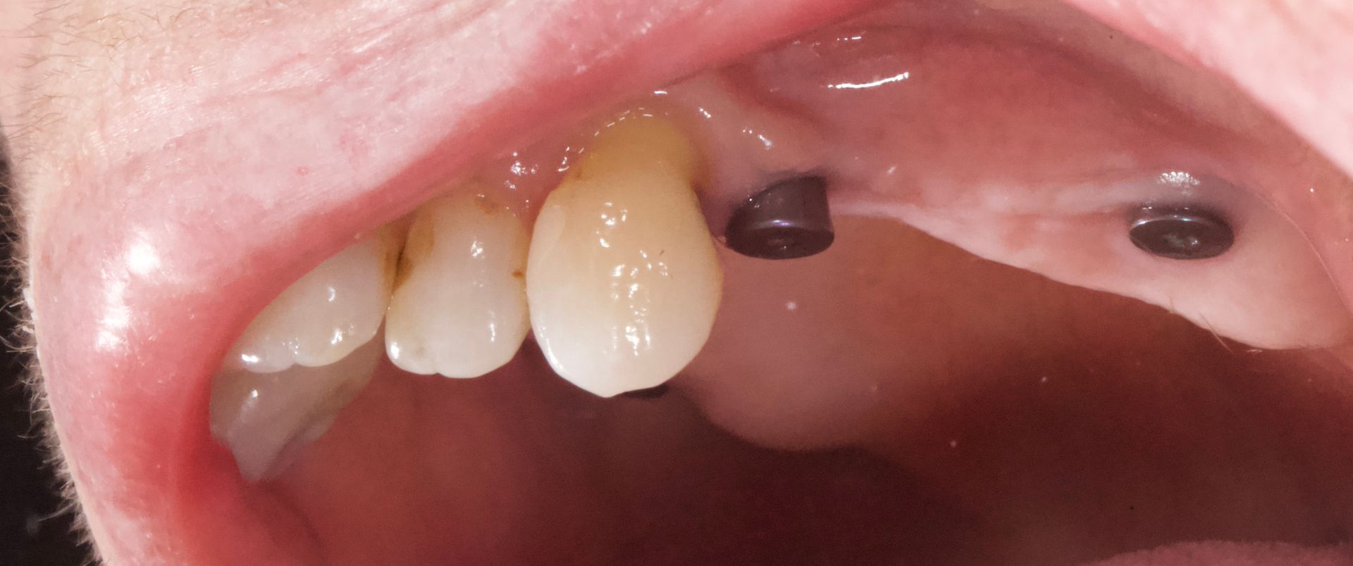 Close-up of an open mouth showing upper teeth and dental work with dark filling or implant holes