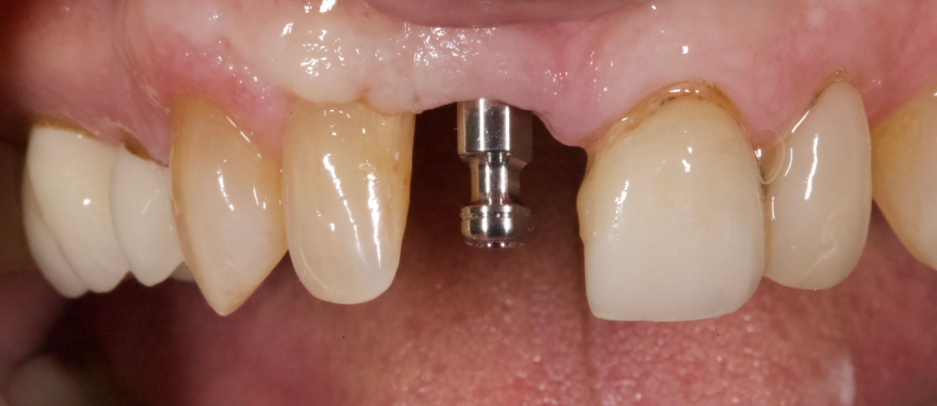 Close-up of front teeth with a dental implant abutment in the center gap