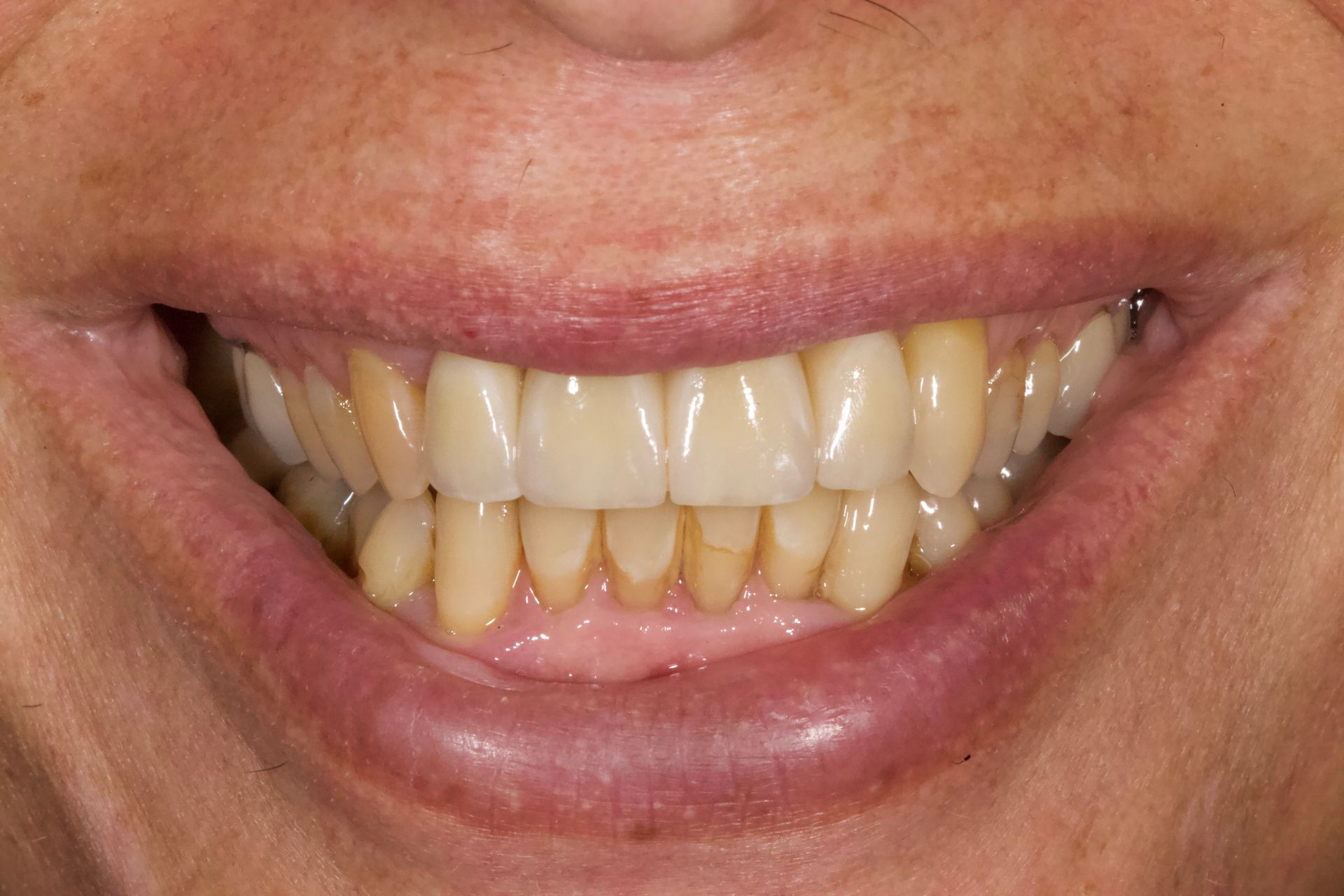 Close-up of a smiling mouth showing yellowed teeth and gums