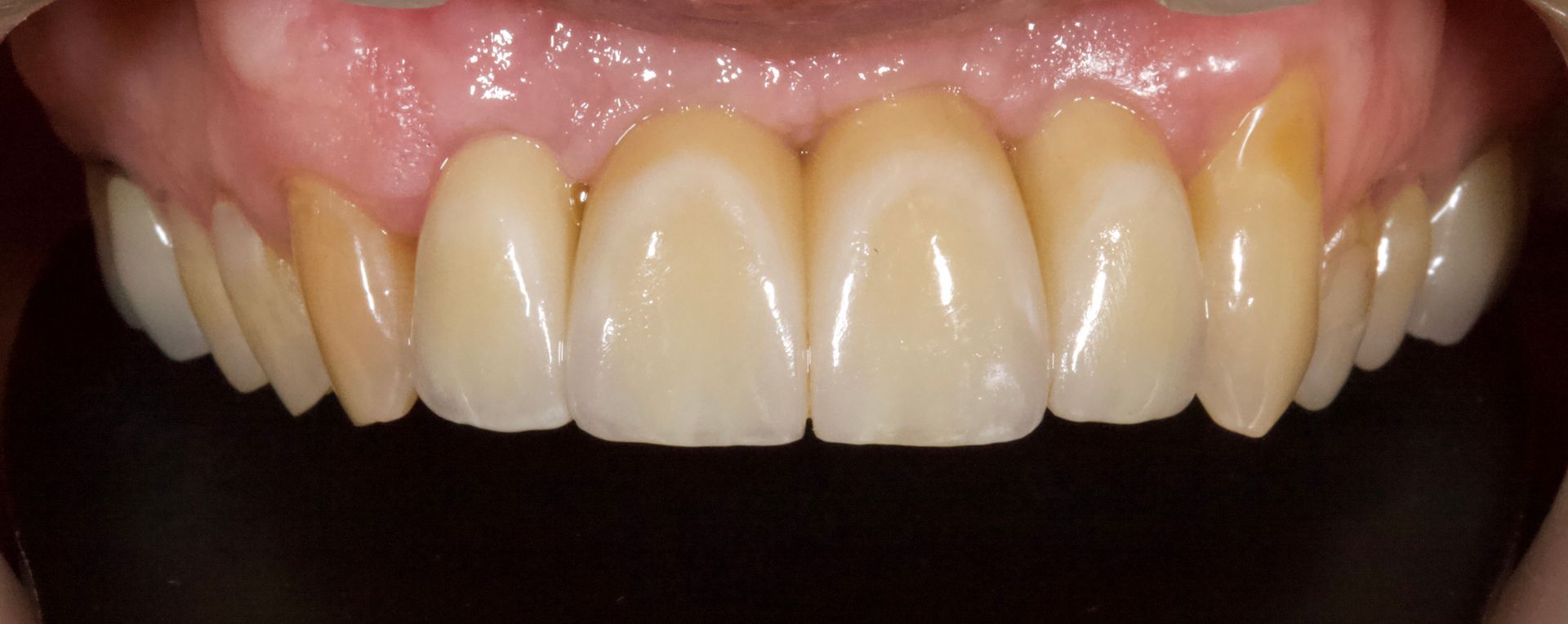 Close-up of upper front teeth with yellow staining and pink gums against a black background