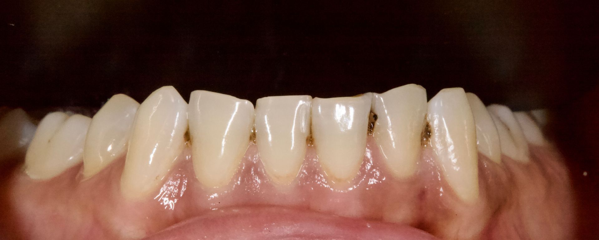 Close-up of upper teeth with visible spacing and pink gums against a dark background