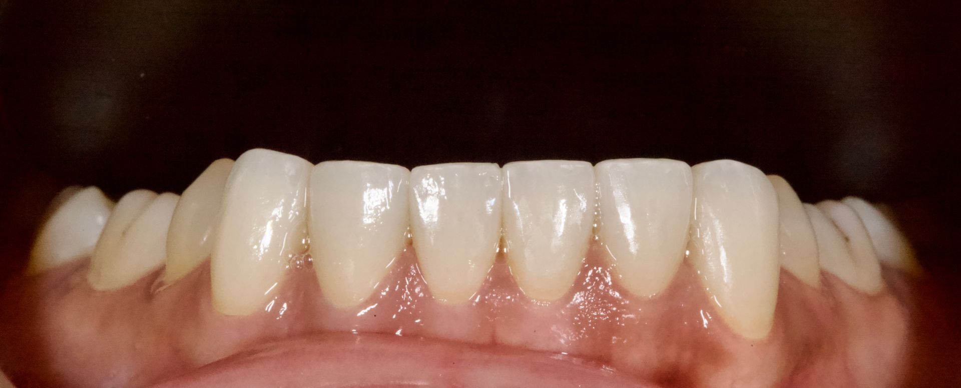 Close-up of upper front teeth with visible crowding and slight discoloration against a dark background