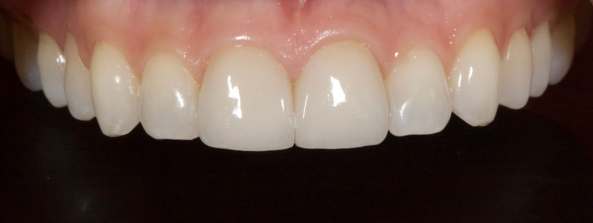 Close-up of a person’s smile showing straight, white upper teeth and pink gums