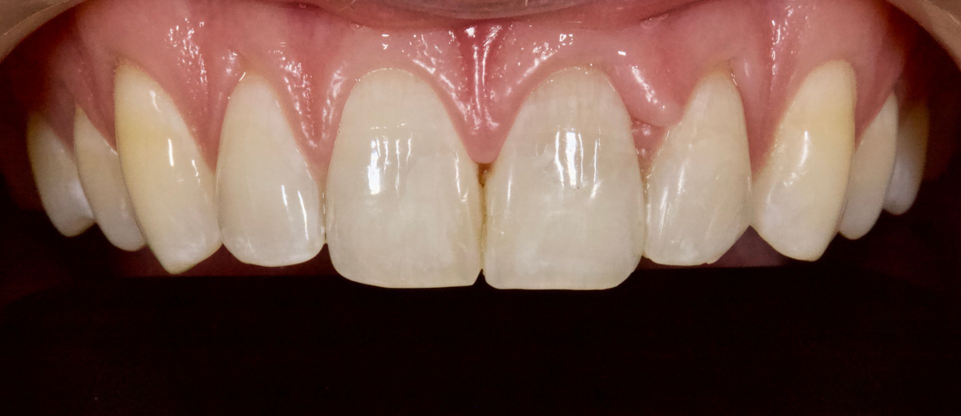 Close-up of upper front teeth and gums, showing a bright white smile
