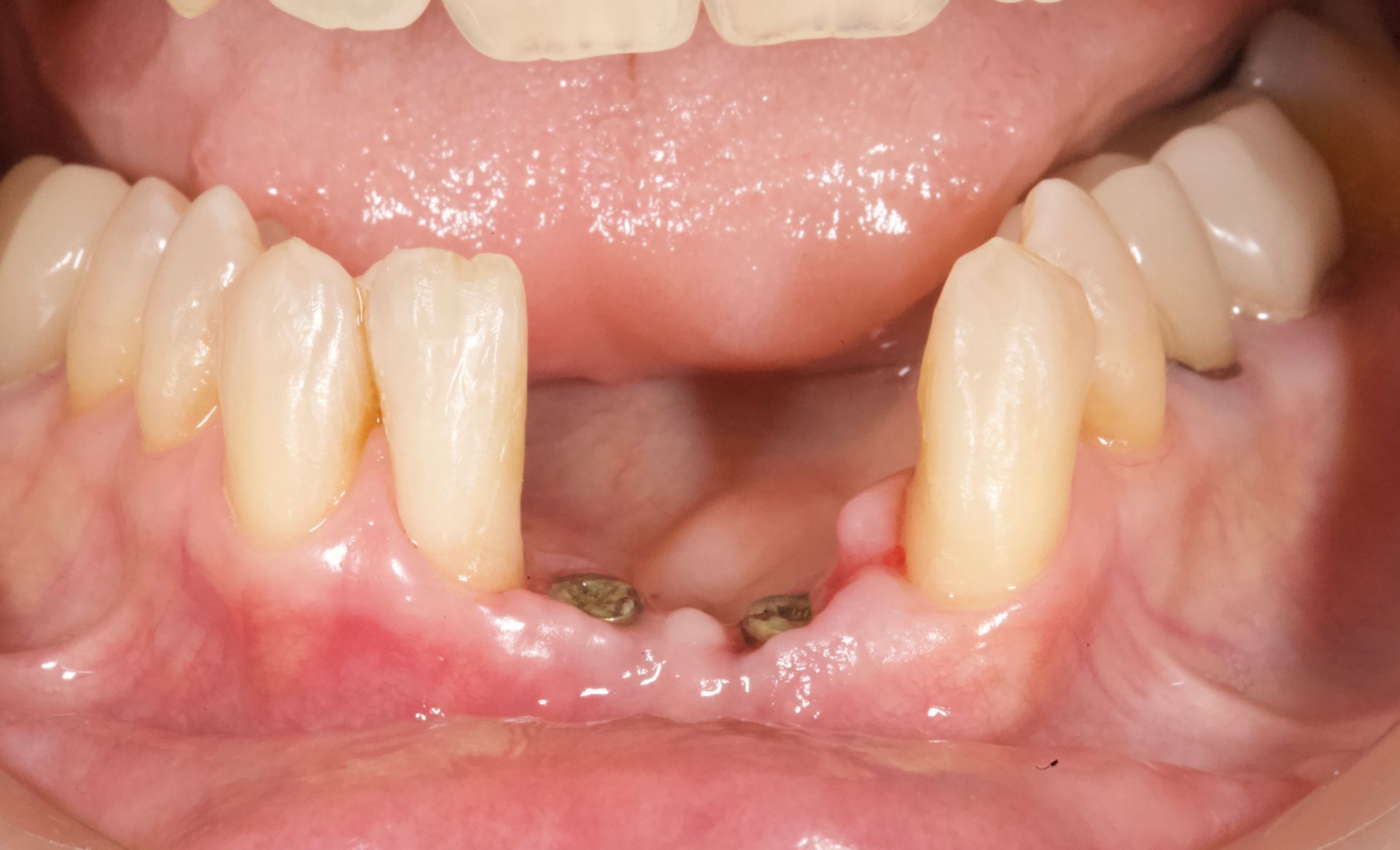 Close-up of lower front teeth with a visible gap and a few missing teeth, pink gums exposed