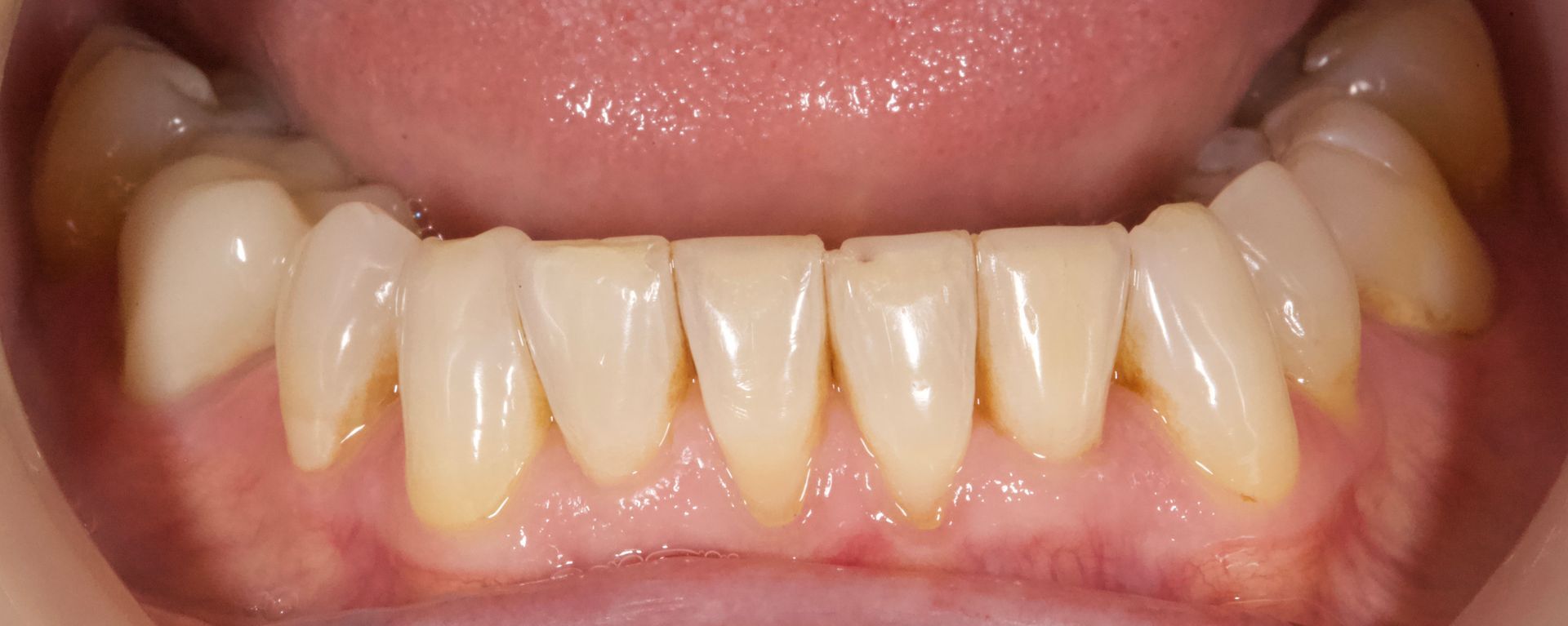 Close-up of a mouth showing upper and lower front teeth with slight yellowing and gaps