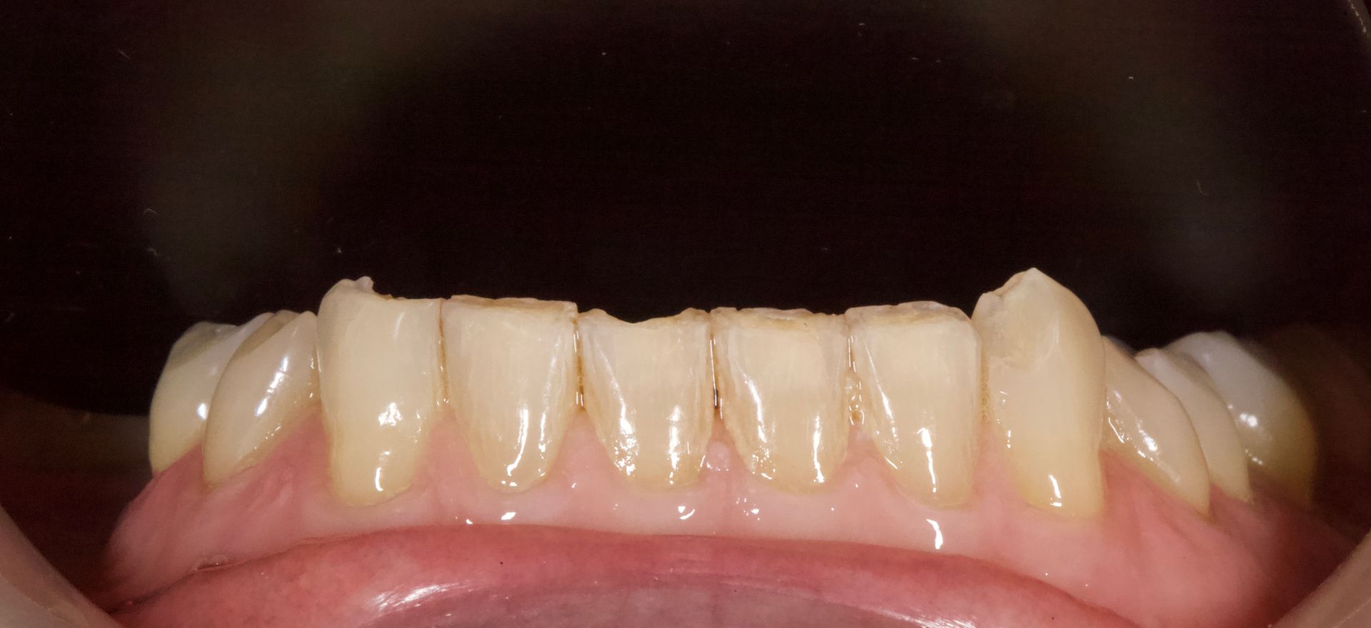 Close-up of yellowed front teeth with visible gaps and a pink lower lip