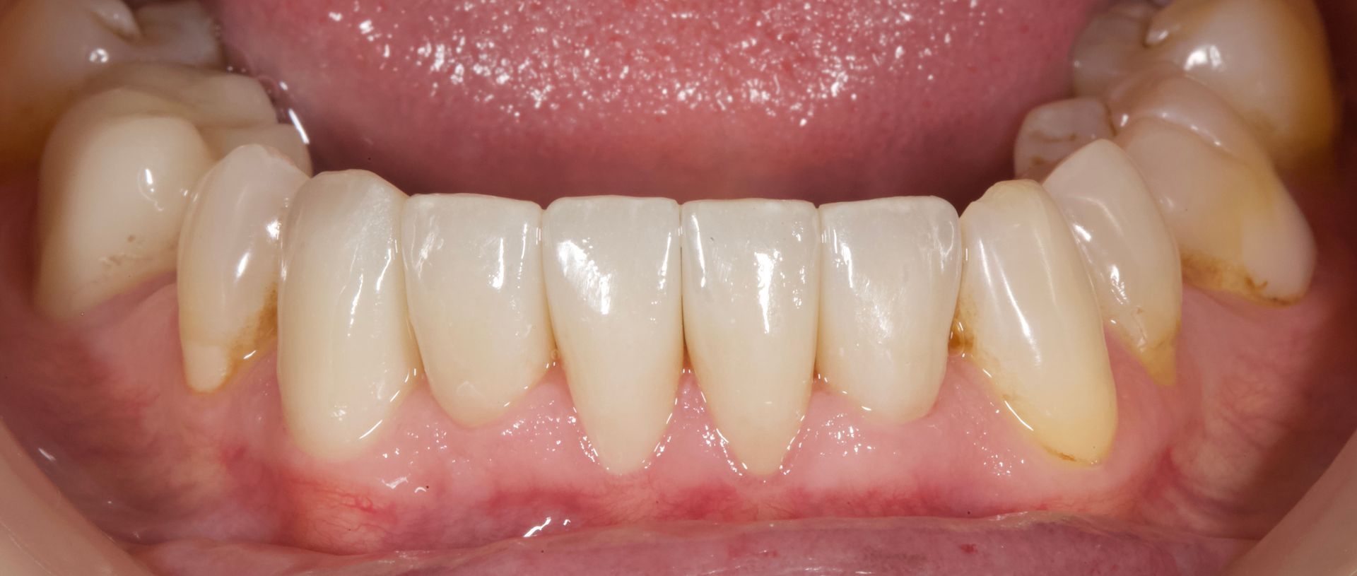 Close-up of lower teeth and gums with slight yellow staining and crowding