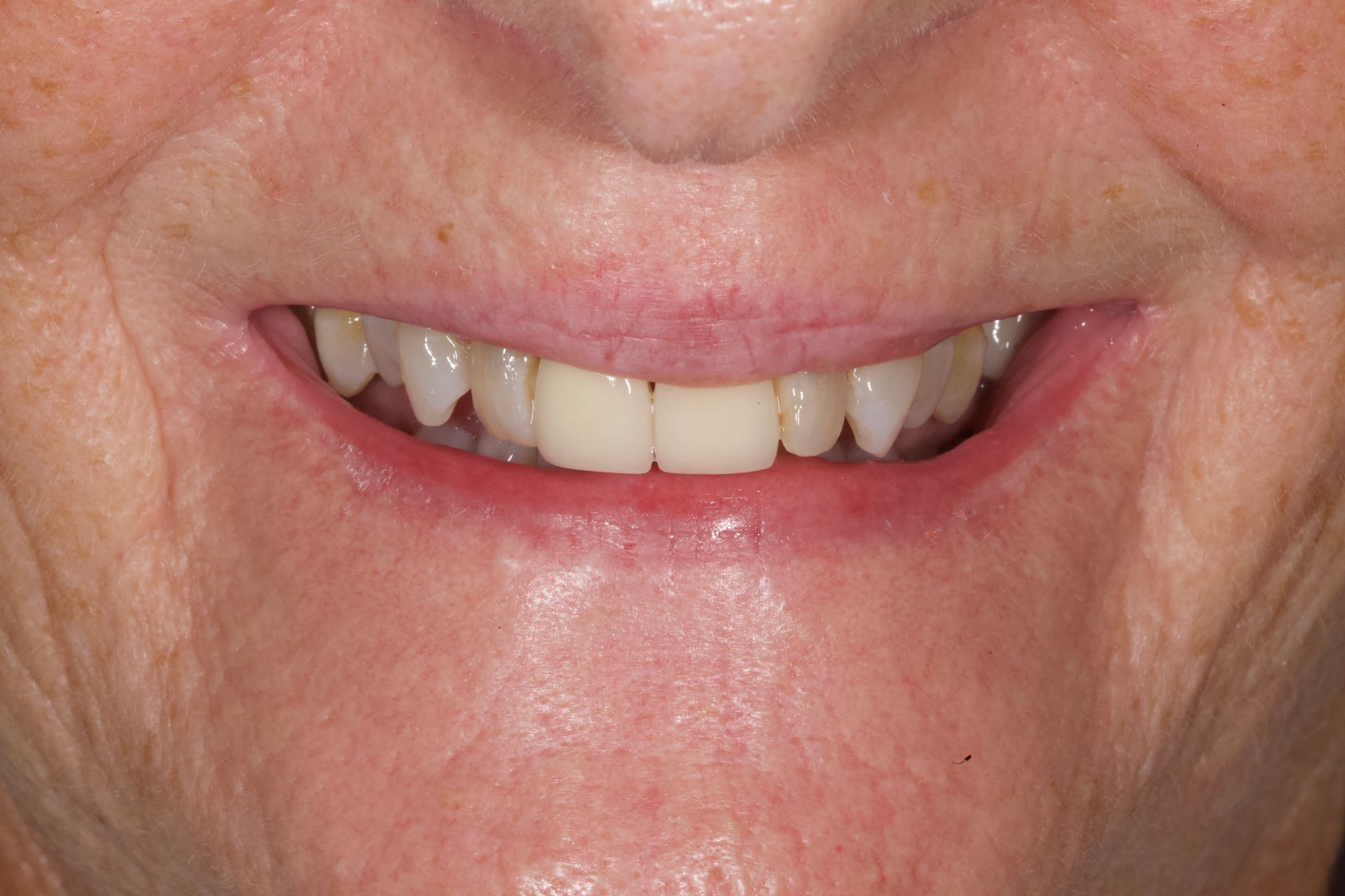 Close-up of a smiling mouth showing upper teeth with a missing front tooth