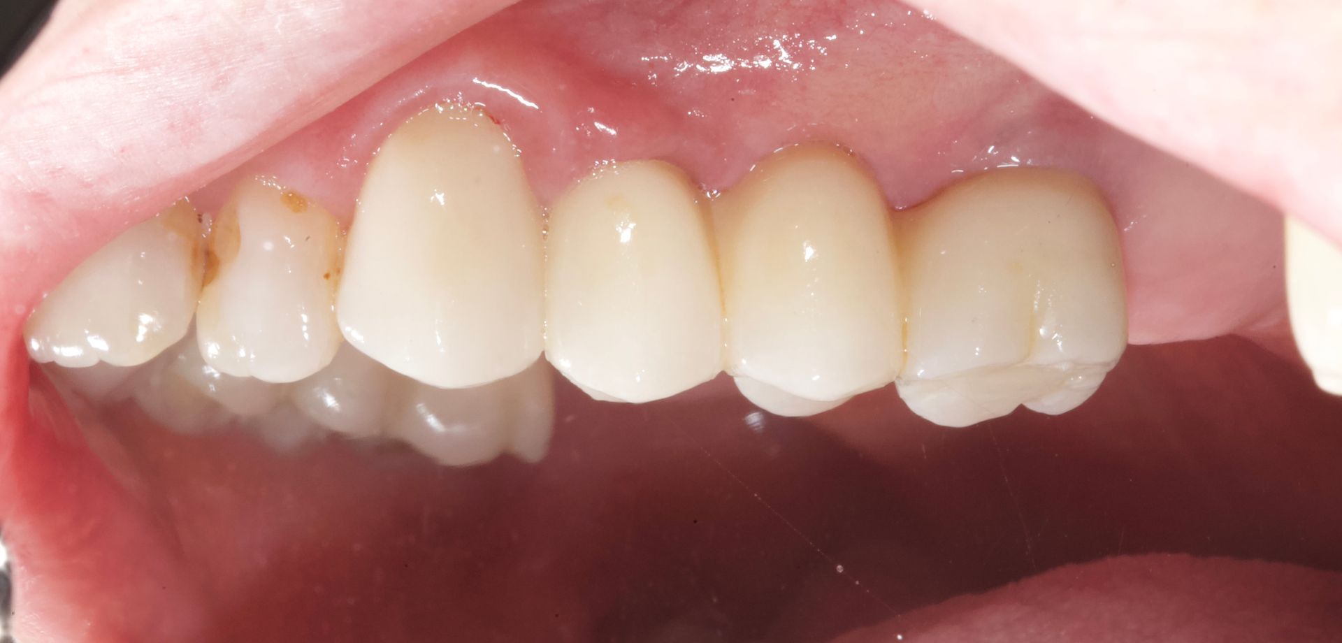 Close-up of upper front teeth with a white dental crown and gums visible