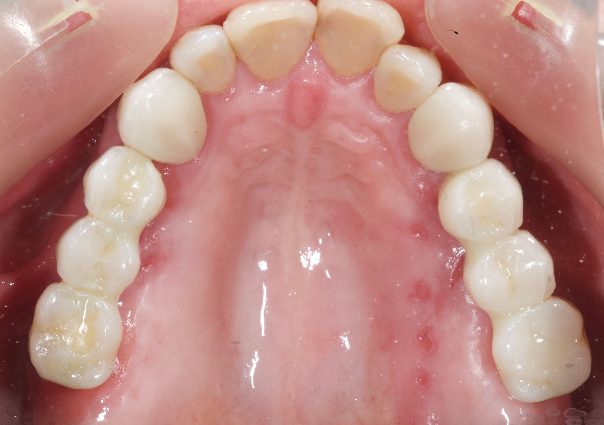 Close-up of upper teeth and palate inside an open mouth, showing the top dental arch.