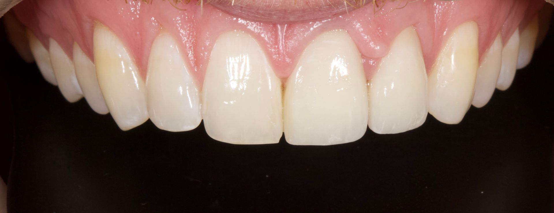 Close-up of smiling mouth with straight white teeth and pink gums