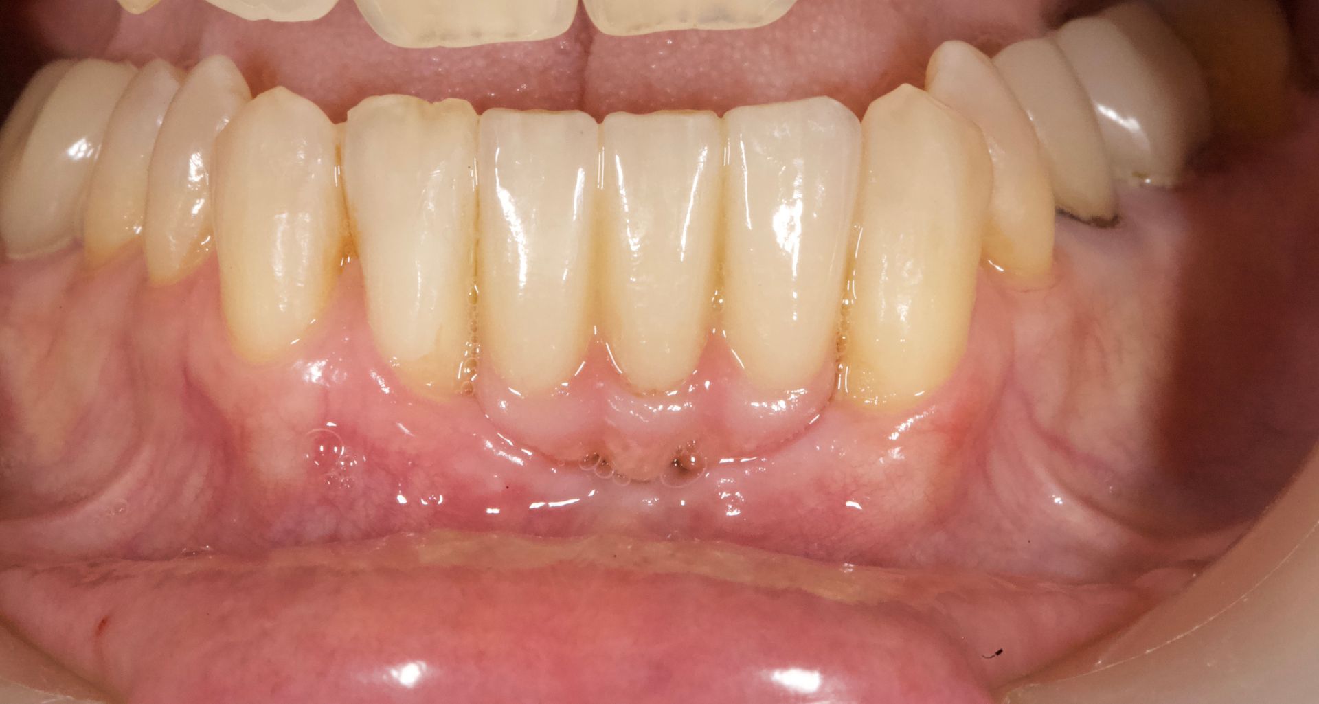 Close-up of teeth and gums with a reddish inflamed lower gumline