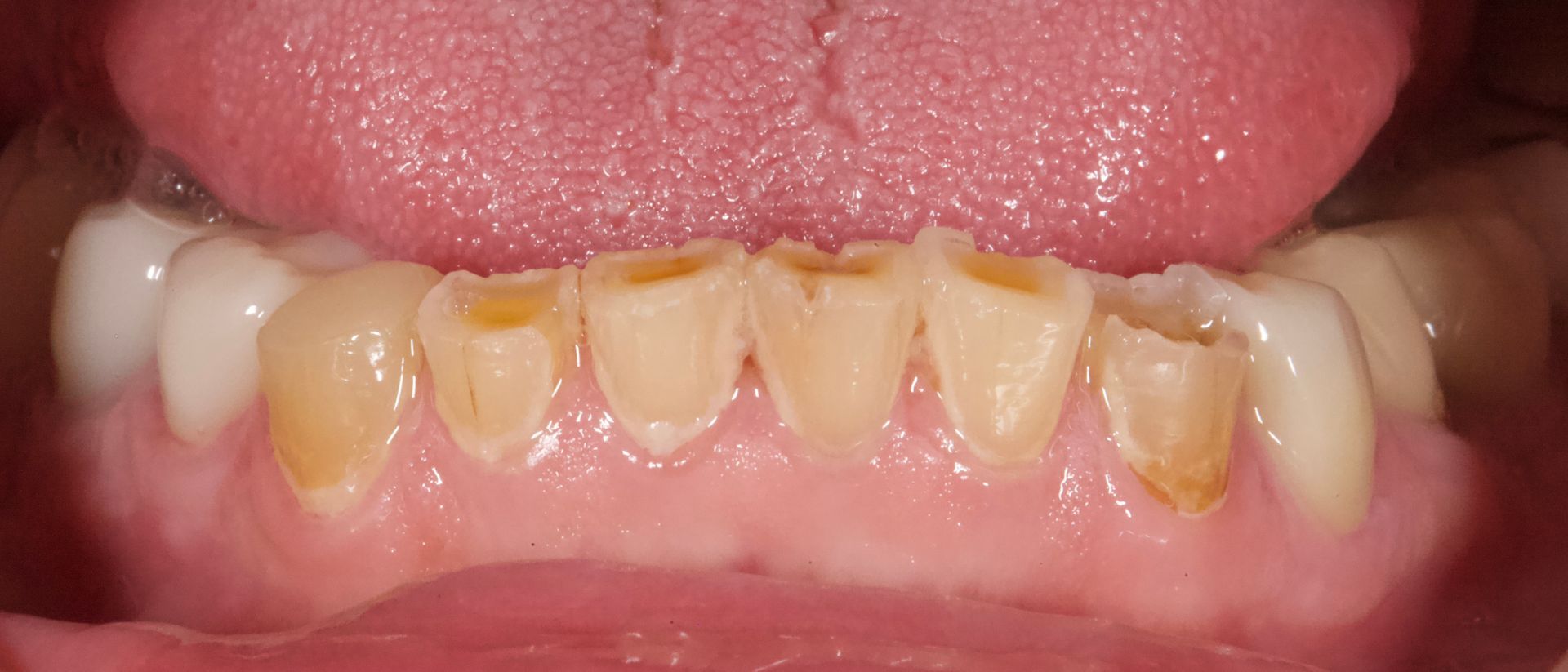Close-up of lower teeth with yellow staining and plaque buildup, mouth open with tongue visible