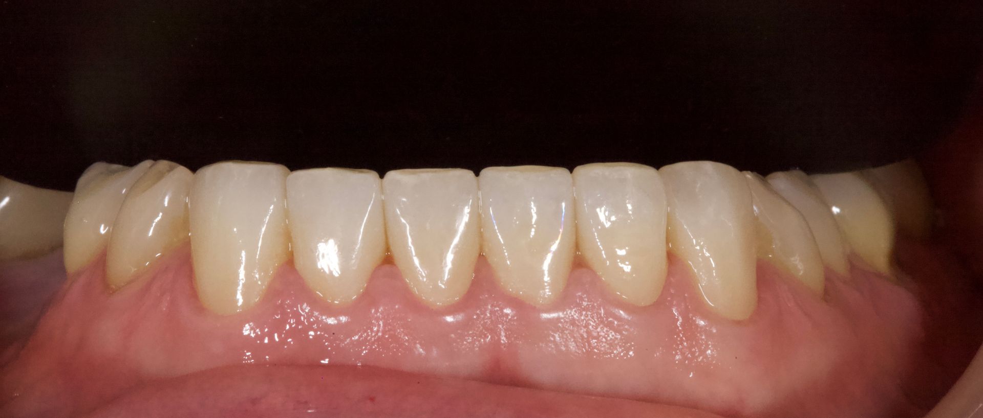 Close-up of a person’s lower teeth and gums, showing a slight gap between the front teeth